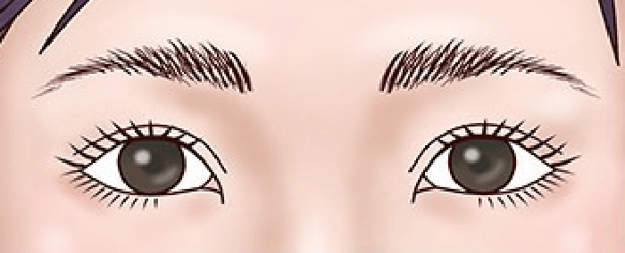 経結膜眼瞼下垂手術 後の目元イラスト